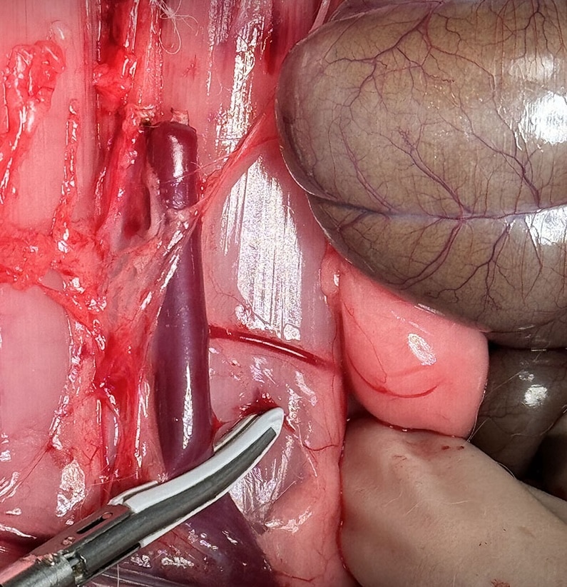 Close-up of surgical anatomy in abdominal operation