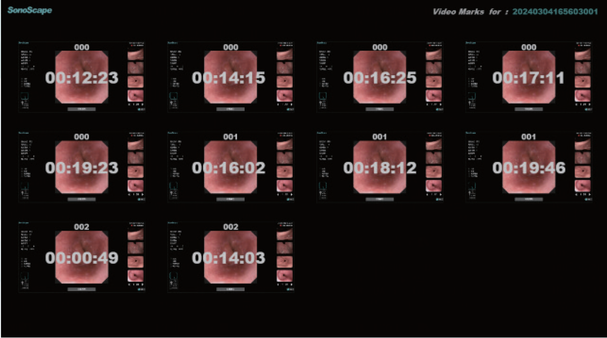 SonoScape veterinary surgery, SonoScape 4K endoscopy, veterinary surgical endoscopy system, 4K MIS endoscope for vets, veterinary laparoscopy 4K, veterinary arthroscopy 4K, rigid endoscope veterinary, small animal surgical endoscopy, equine surgical endoscope, advanced veterinary surgery imaging, high-definition veterinary endoscopy, 4K surgical video system vet, veterinary minimally invasive surgery equipment, veterinary operating room imaging, vet med surgical endoscope platform, buy veterinary surgical endoscope, SonoScape endoscopy for sale, veterinary hospital surgery equipment, zoo medicine surgical endoscopy, veterinary GI surgery endoscope, veterinary ortho endoscopy, veterinary thoracoscopy 4K, veterinary abdominal surgery imaging, MIS equipment for veterinarians